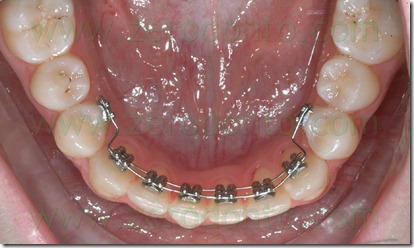 Restoration of a lower incisor's periodontal health by means of a ...